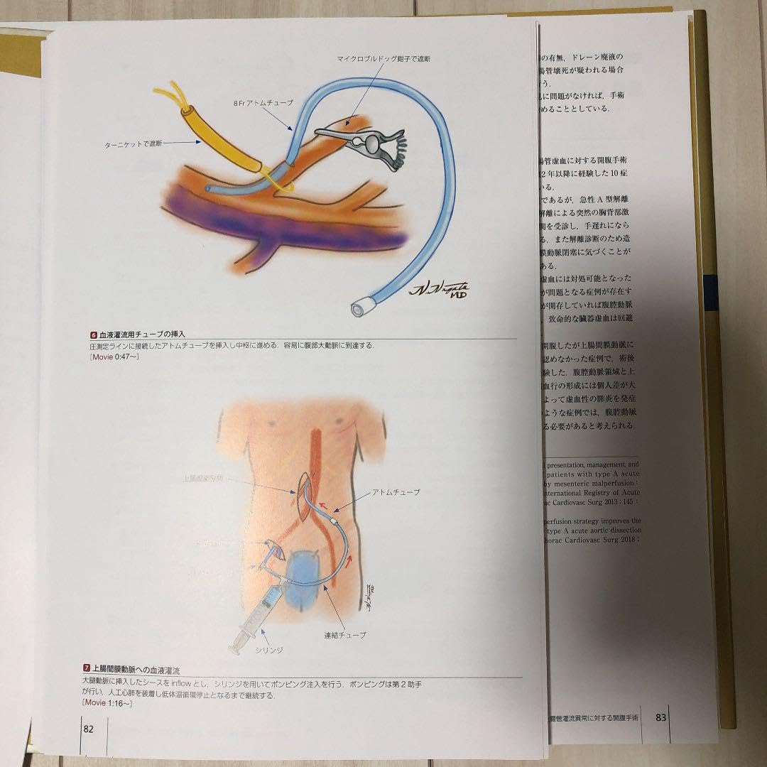 Amazon.co.jp: 心臓血管外科エクセレンス大動脈疾患手術 第4巻 : 産業